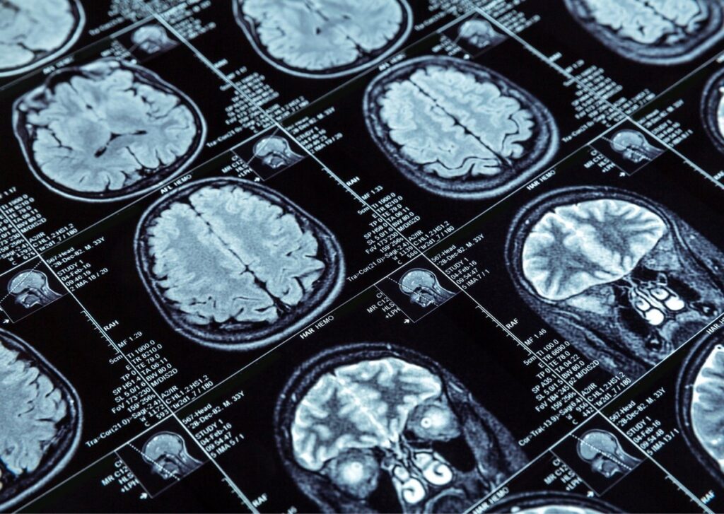 Pesquisa da UFMG desenvolve método para tratar câncer cerebral