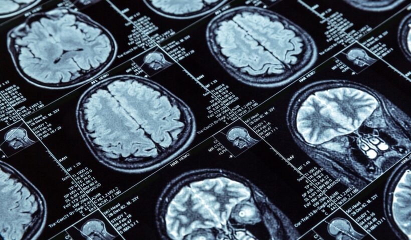 Pesquisa da UFMG desenvolve método para tratar câncer cerebral